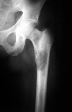 reticulum cell sarcoma x ray