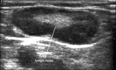 Ultrasound image of a lymph node with its characte