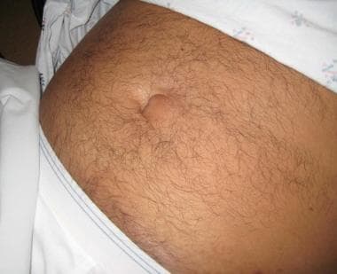 Open femoral hernia repair reveals a hernia sac containing a necrotic