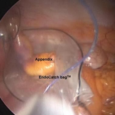 Placement of appendix in endoscopic specimen retri