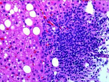 hepatitis c liver histology