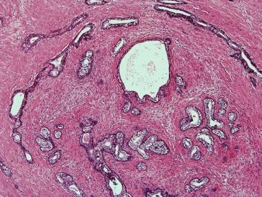 prostate cancer treatment effect histology