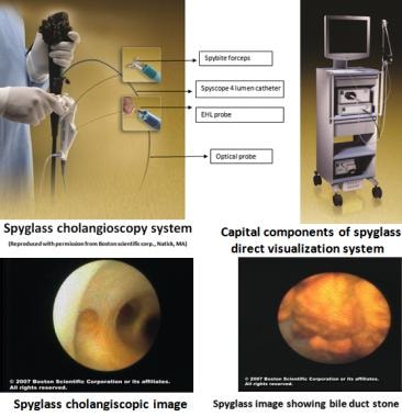 Spyglass System and images from the biliary system