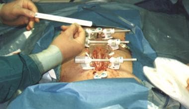 Figure S. Different devices for temporary abdominal closure for planned