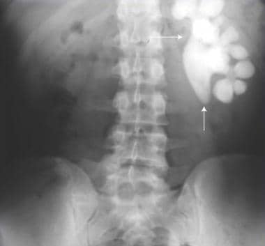 Plain film of the abdomen revealing a radiopaque s