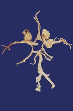 Circle of Willis has been dissected, and three ber