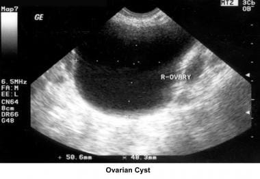 Infertility. Ovarian cyst. Image courtesy of Jairo