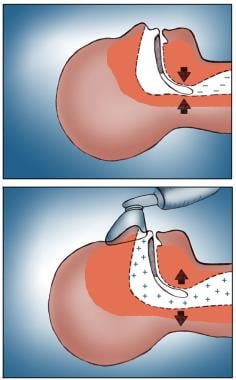 Breathing-related sleep disorder. Before and after