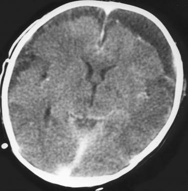 Subdural empyema and diffuse cerebral edema in a p