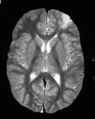 Axial T2-weighted axial MRI obtained at 2-year fol