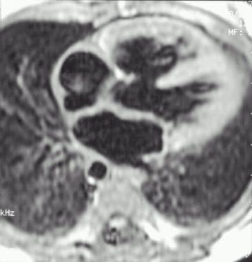 Magnetic resonance image of the heart in an infant