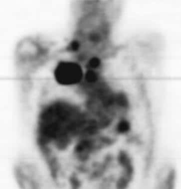 Lung cancer, small cell. Coronal positron emission