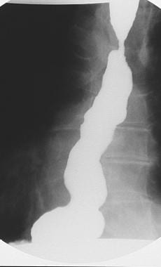 Spot radiograph shows spontaneous severe gastroeso