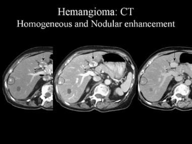 cavernous hemangioma liver ultrasound