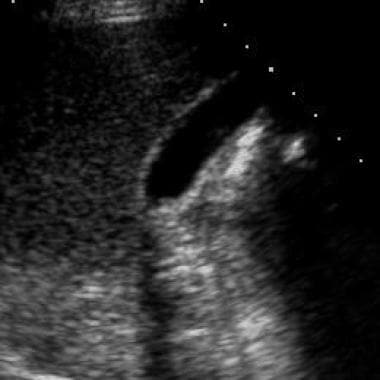 Cholelithiasis. Do not confuse the reflective echo