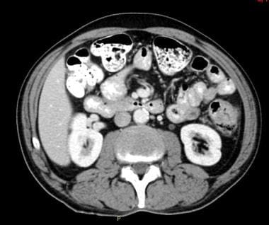 Patient undergoing staging for adenocarcinoma of t