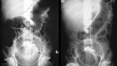 A 22-year-old man presented with abdominal pain, p