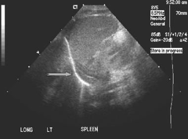 A normal adrenal gland is often identified by ultr