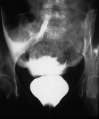 Conventional cystogram demonstrating an intraperit