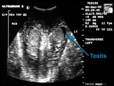 Transverse ultrasonogram of both testes demonstrat