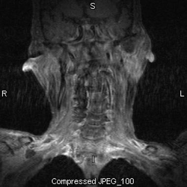Parotid, malignant tumors. Coronal T2-weighted MRI