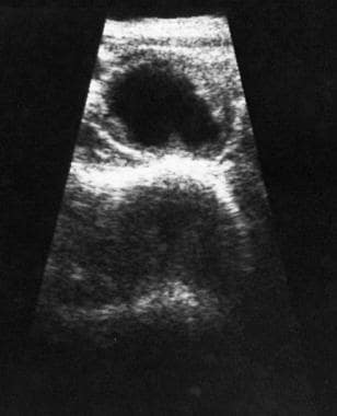 Sonogram demonstrates a benign cystic lesion in th