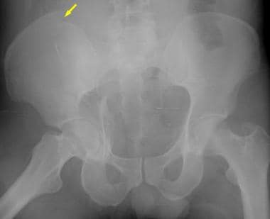 Both-column acetabular fracture. An anteroposterio