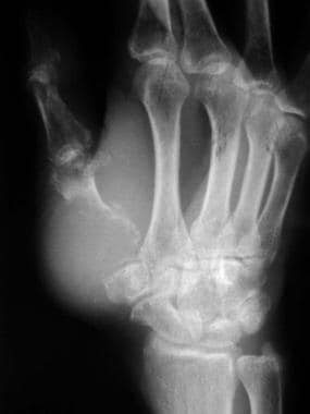 Bone metastases to the finger. Radiograph shows a 