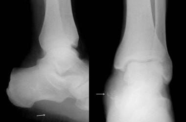 Calcaneus, fractures. This patient presented follo