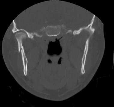 This coronal computed tomography scan clearly show