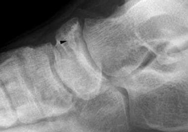 Lateral radiograph of the ankle reveals a cortical