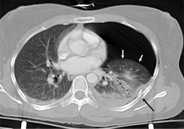 Tomographie axiale assistée par ordinateur du thorax d'un
