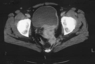 This CT image demonstrates a cervical tumor direct
