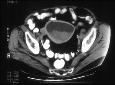 A 74-year-old woman with moderately differentiated