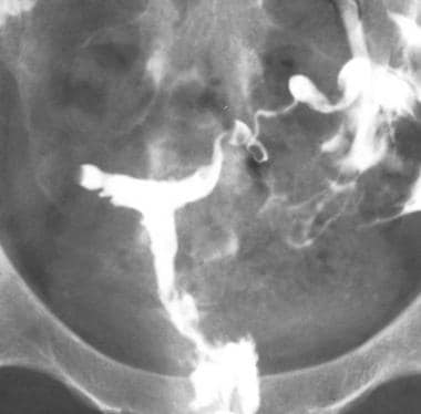 Uterus, müllerian duct abnormalities. T-shaped ute