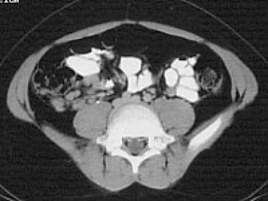 Abdominal CT scan shows a cluster of enlarged node