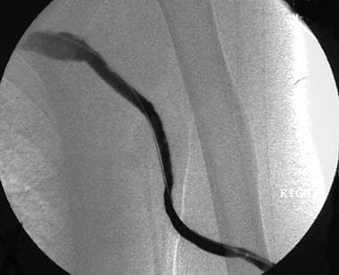 Image obtained after percutaneous transluminal ang