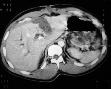 Contrast-enhanced CT demonstrating a liver lacerat