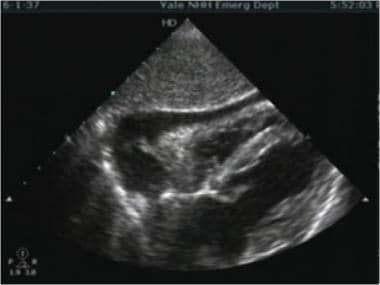 pericardial effusion ultrasound