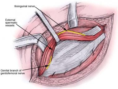 Open inguinal hernia repair. Fixation of lower edg