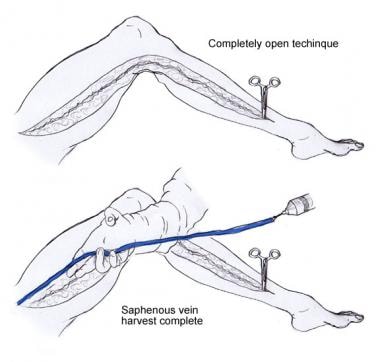 Critical Analysis of Coronary Artery Bypass Graft Surgery: A 30