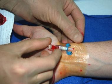 Radial artery cannulation (modified Seldinger). St
