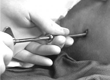 Trephine is inserted into outer guide and rotated 