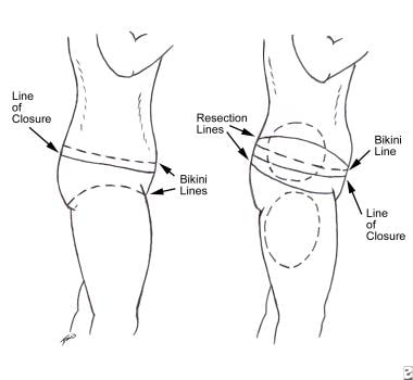 Preoperative markings, lateral view. 