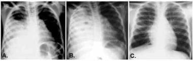 Most parapneumonic effusions treated with the appr