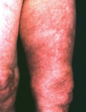 A 68-year-old woman with a history of untreated er