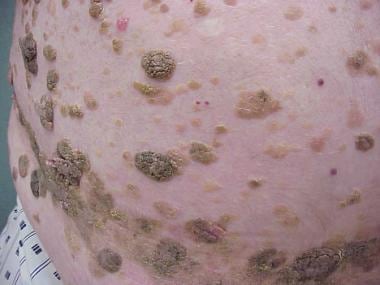 Closer view of multiple seborrheic keratoses in an