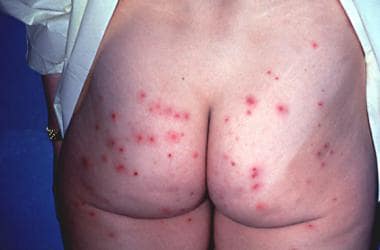 A 30-year-old woman with hot tub folliculitis. She
