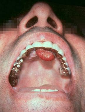 A large soft-tissue mass on the gingiva resembles 