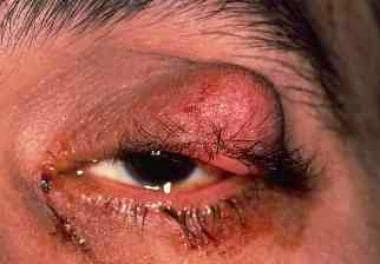 Sebaceous carcinoma of the upper eyelid. Courtesy 